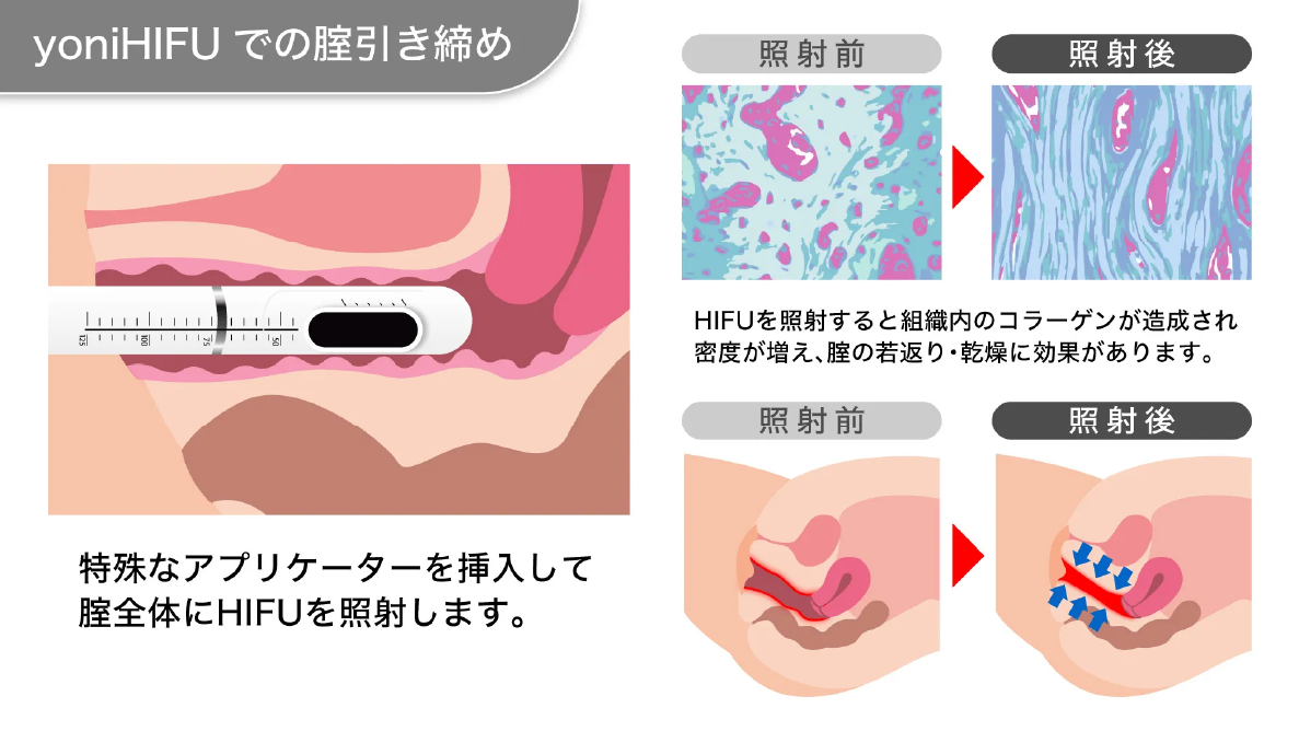 yoniHIFU IIIとは