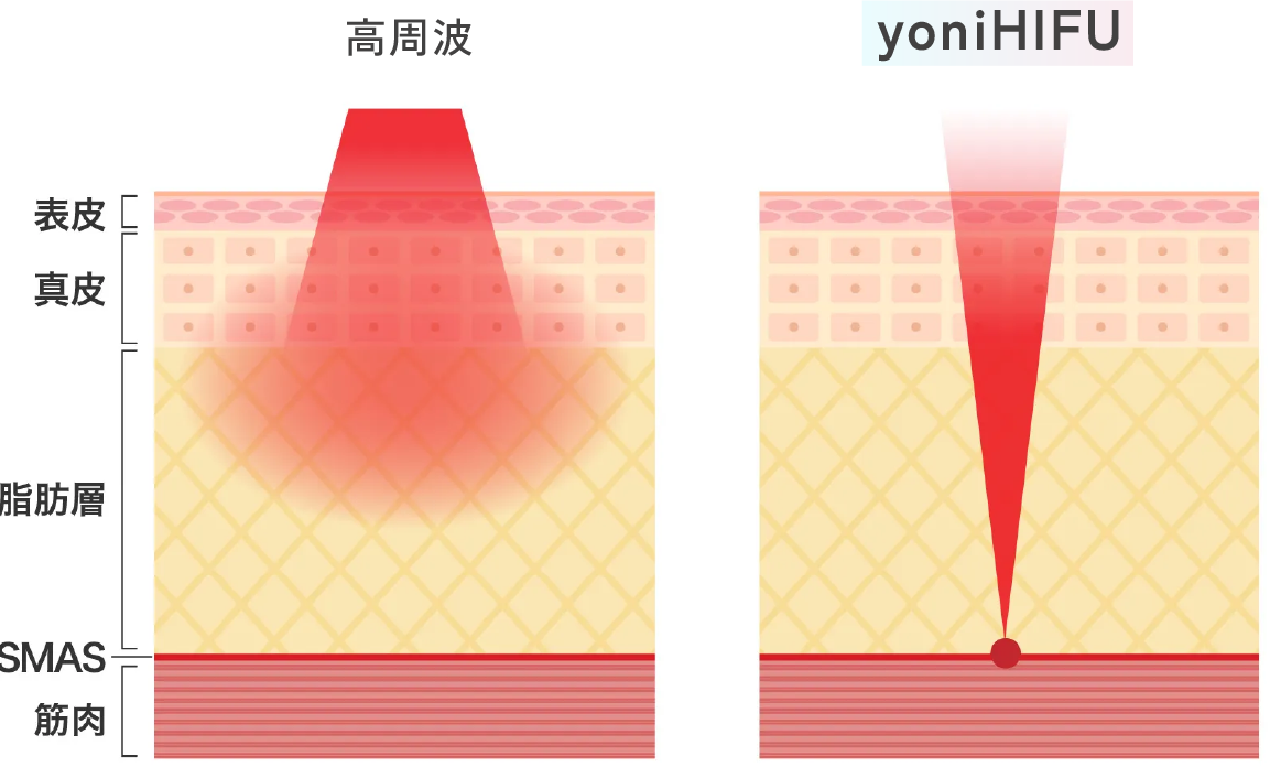 yoniHIFU IIIとは
